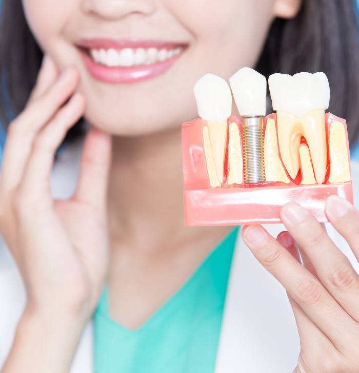 A dentist holding an enlarged model of a dental implant