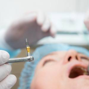 A dentist holding a dental implant during a surgery 