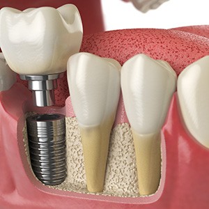 A 3D illustration of a dental implant and its parts