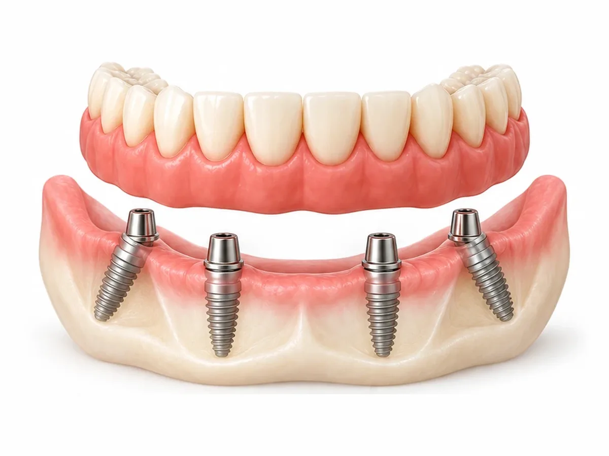 Illustration of a full-arch denture held by four dental implants, the back two angled