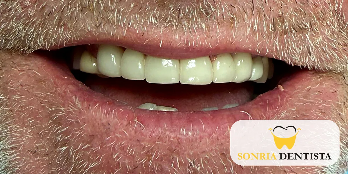Smile after treatment with even, lighter upper front teeth