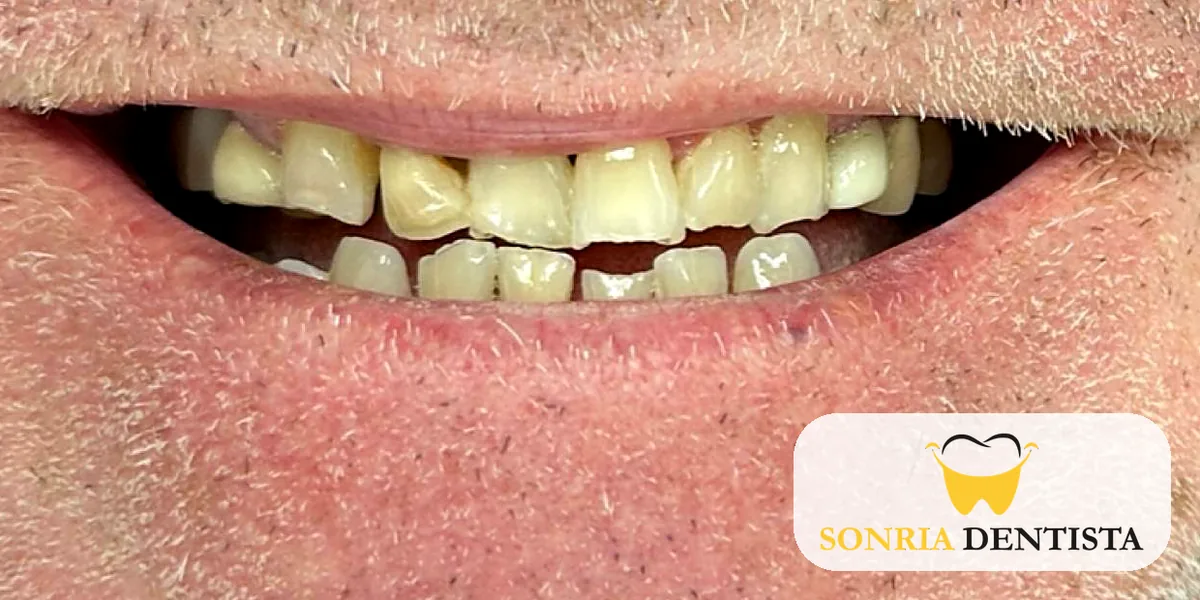 Smile before treatment with worn, discolored and uneven upper front teeth