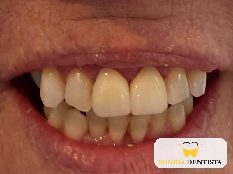 Close-up smile after treatment with restored upper front teeth
