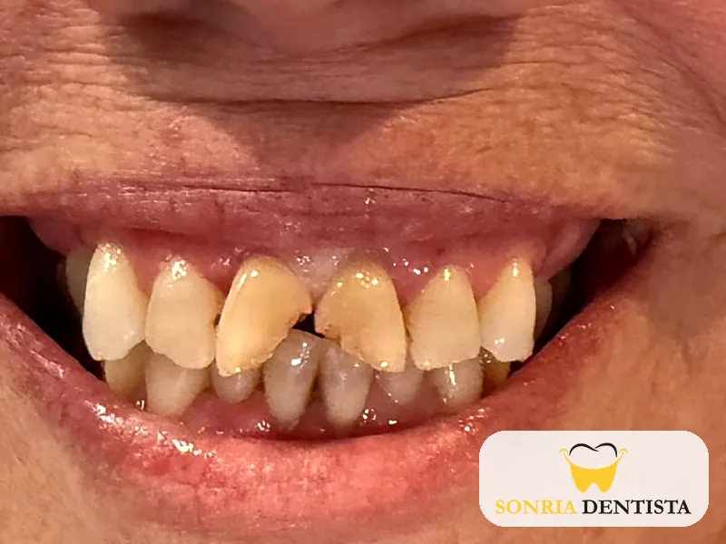 Close-up smile before treatment with chipped, discolored upper front teeth