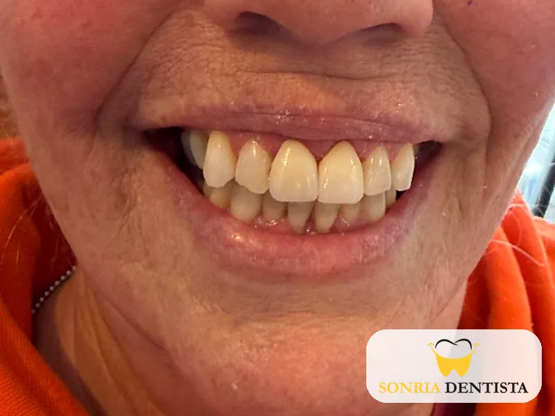Full smile after treatment with restored upper front teeth