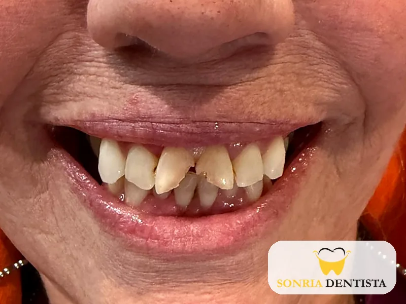 Full smile before treatment with broken upper front teeth