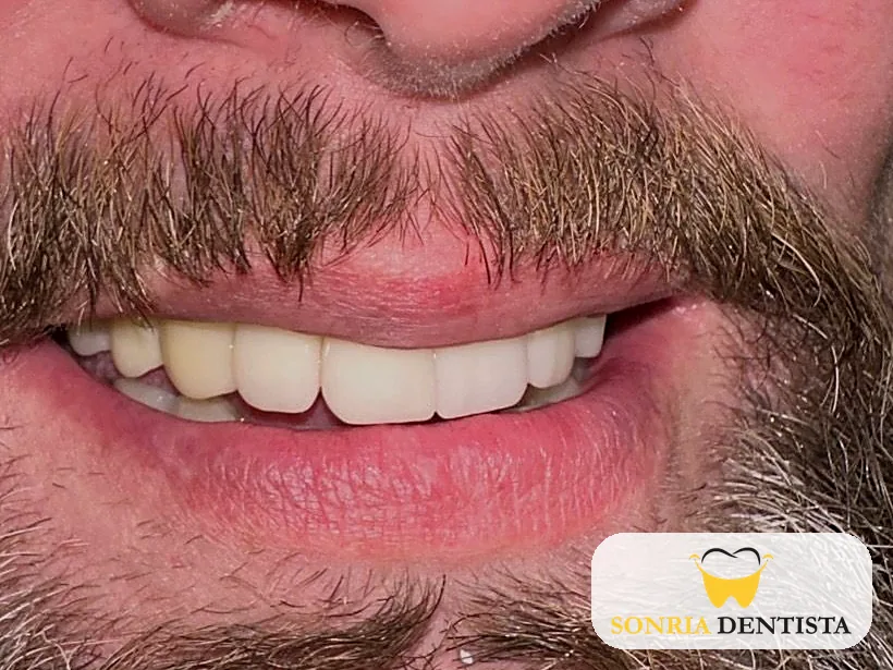 Smile after treatment with even, white upper teeth