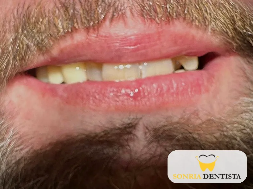 Smile before treatment with worn, yellowed teeth and a missing tooth