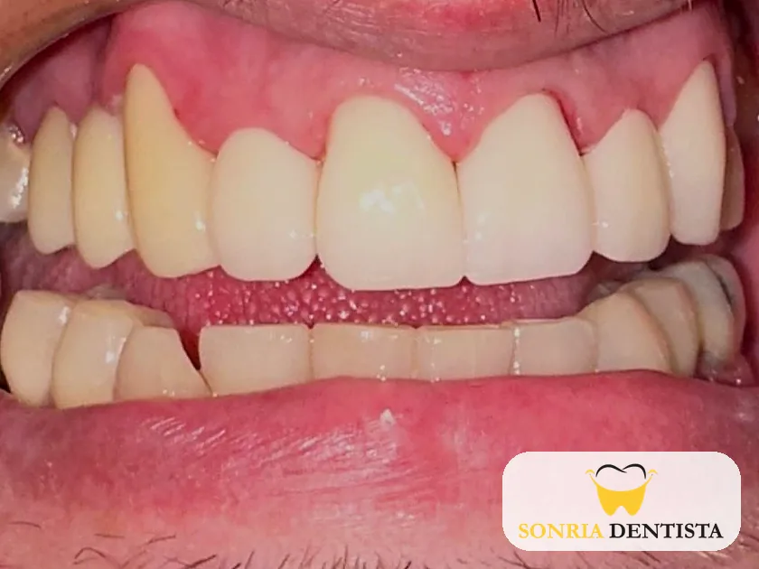 Close-up of teeth after treatment showing restored upper teeth
