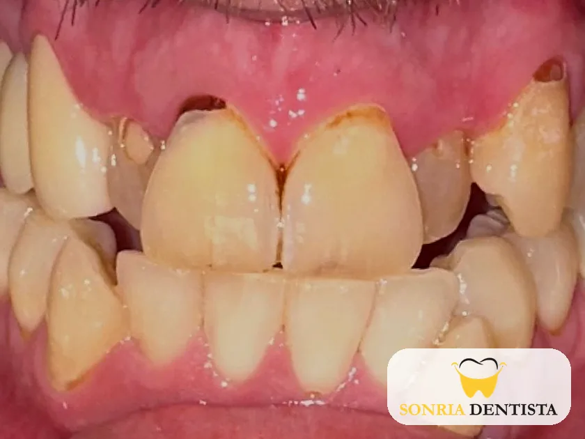 Close-up of teeth before treatment showing broken, crowded and discolored teeth