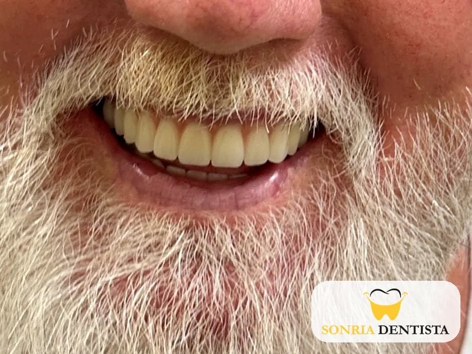 Smile after treatment with a full set of upper and lower teeth