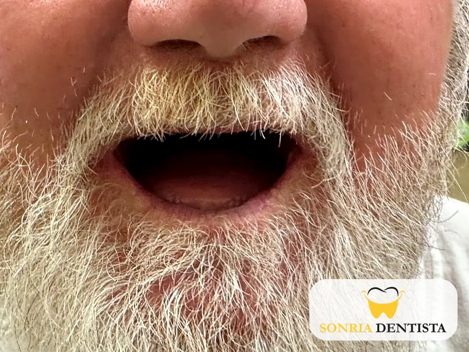 Open mouth before treatment showing no visible teeth