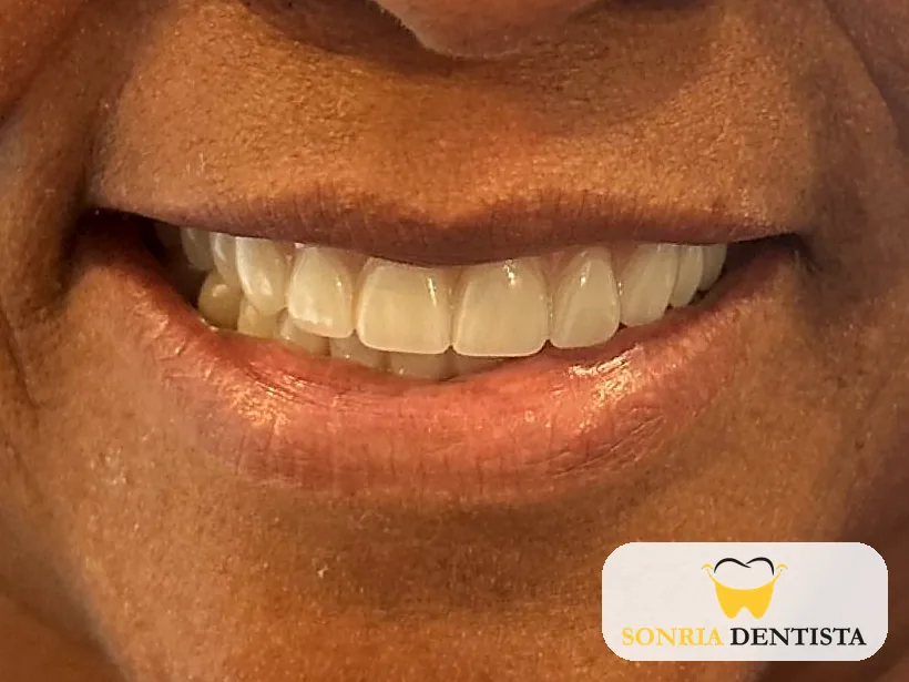 Smile after treatment with a full set of teeth