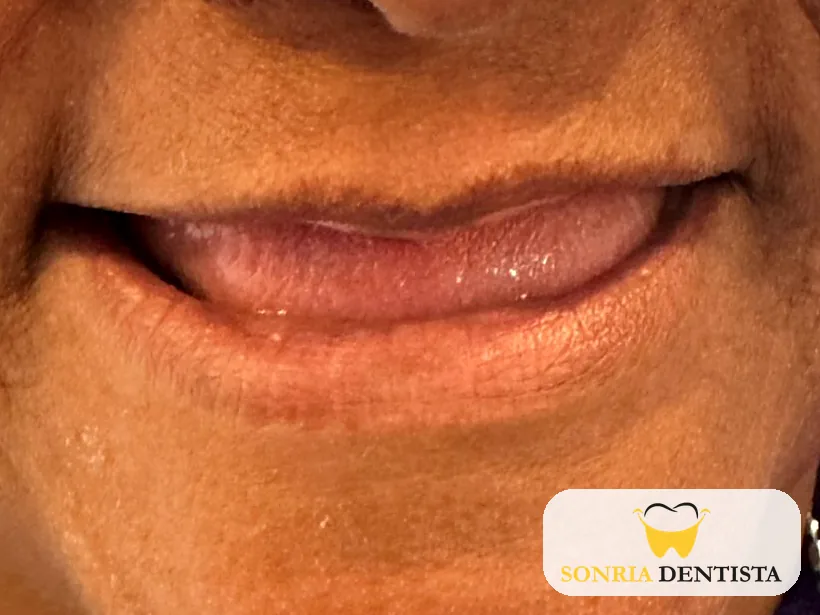 Smile before treatment with no visible teeth